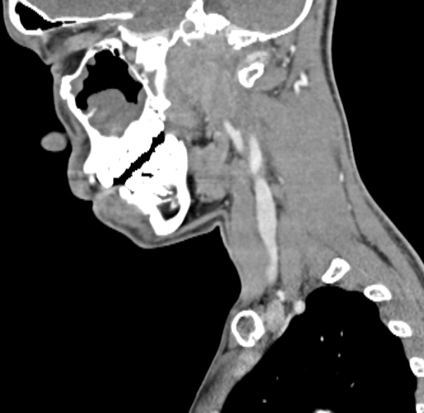 Nasopharyngeal carcinoma with skull base invasion (Radiopaedia 53415-59705 C 50).jpg