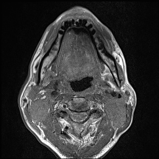 File:Nasopharyngeal carcinoma with skull base invasion (Radiopaedia 59258-66600 B 37).jpg