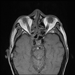 File:Nasopharyngeal carcinoma with skull base invasion (Radiopaedia 59258-66600 B 9).jpg