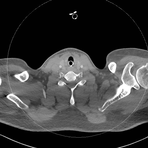 Neck CT angiogram (intraosseous vascular access) (Radiopaedia 55481-61945 B 141).jpg