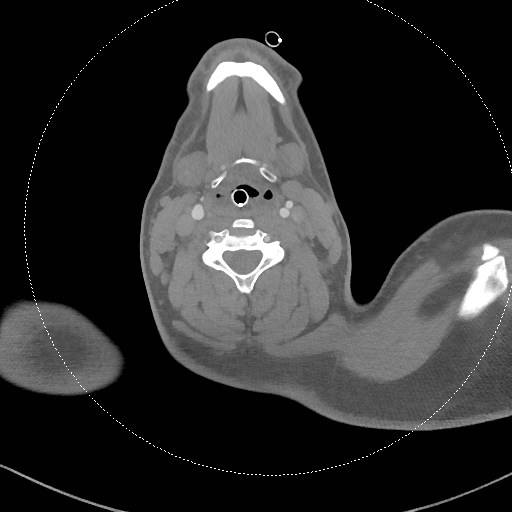 Neck CT angiogram (intraosseous vascular access) (Radiopaedia 55481-61945 B 181).jpg