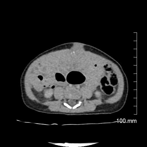 File:Neonatal neuroblastoma (Radiopaedia 56651-63438 Axial non-contrast 53).jpg