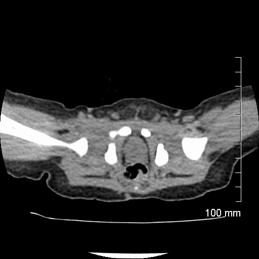 File:Neonatal neuroblastoma (Radiopaedia 56651-63438 Axial non-contrast 79).jpg