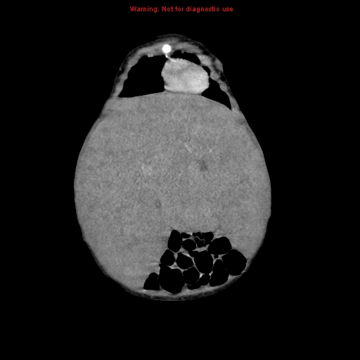 File:Neonatal neuroblastoma (Radiopaedia 9564-10223 B 33).jpg