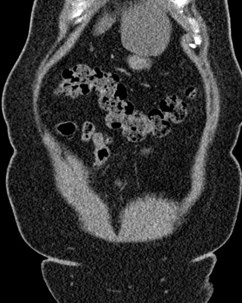 File:Nephrostomy for urosepsis (Radiopaedia 26180-26330 non-contrast 17).jpg