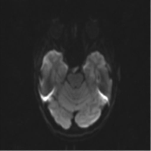 Neurenteric cyst (Radiopaedia 58641-65837 Axial DWI 47).png