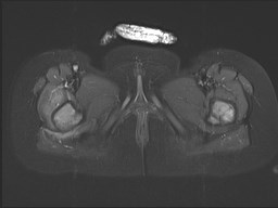 File:Neuroblastoma with bone metastases (Radiopaedia 67080-76414 Axial STIR 41).jpg