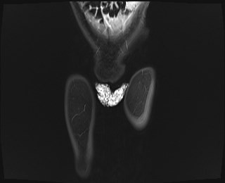File:Neuroblastoma with bone metastases (Radiopaedia 67080-76414 Coronal STIR 1).jpg