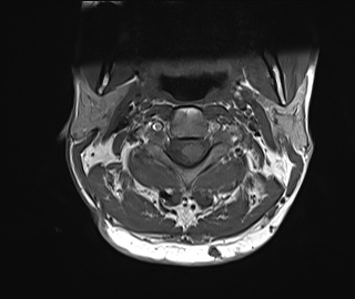 File:Neurofibromatosis type 1 (Radiopaedia 80355-93740 Axial T1 8).jpg