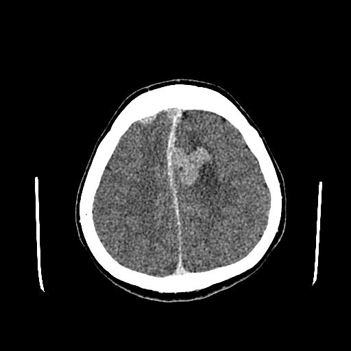 File:Neurofibromatosis type 2 (Radiopaedia 25389-25637 Axial C+ 76).jpg