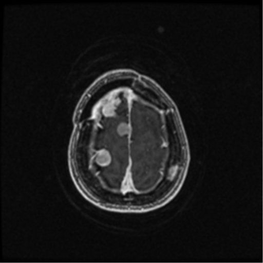 Neurofibromatosis type 2 (Radiopaedia 45229-49244 Axial T1 C+ 101).png