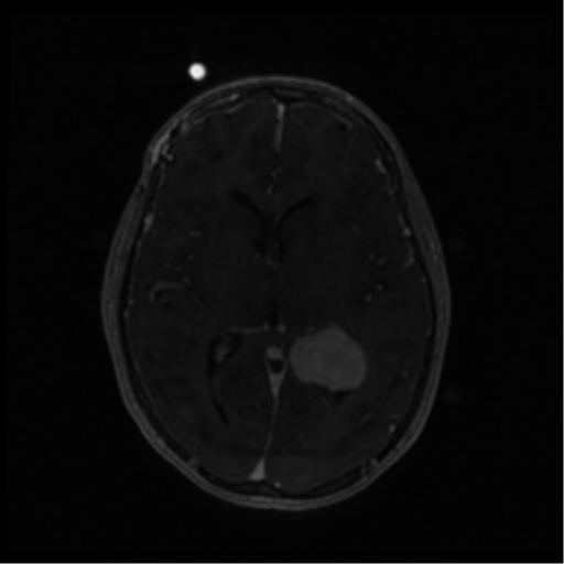 Neurofibromatosis type 2 (Radiopaedia 45229-49244 Axial T1 C+ 66).png
