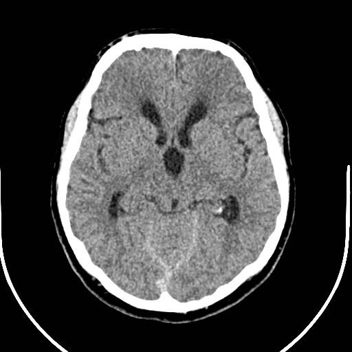 Neurofibromatosis type 2 (Radiopaedia 79097-92047 Axial non-contrast 27).jpg