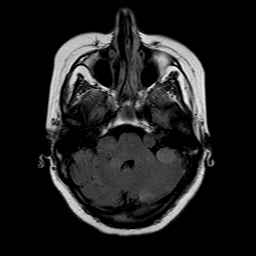 File:Neurofibromatosis type 2 (Radiopaedia 8713-9518 Axial FLAIR 19).jpg