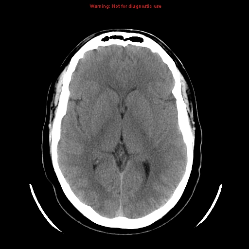 File:Neuroglial cyst (Radiopaedia 10713-11185 Axial non-contrast 17).jpg