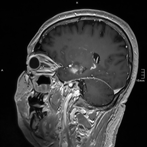 Neurosarcoidosis - involvement of the mesial temporal lobes (Radiopaedia 67429-76820 Sagittal T1 C+ 110).jpg
