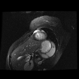 File:Non-compaction of the left ventricle (Radiopaedia 38868-41062 D 4).jpg