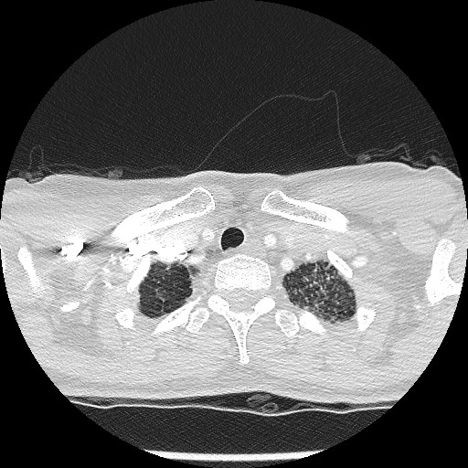 File:Non-small cell lung cancer with miliary metastases (Radiopaedia 23995-24193 Axial lung window 4).jpg