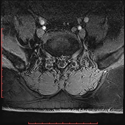 Non Hodgkin's lymphoma with metastasis to spine (Radiopaedia 54844-61103 Axial T1 C+ fat sat 12).jpg