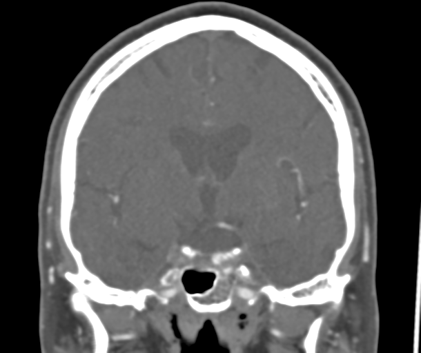 File:Normal CTA head (Radiopaedia 40801-43464 B 48).png