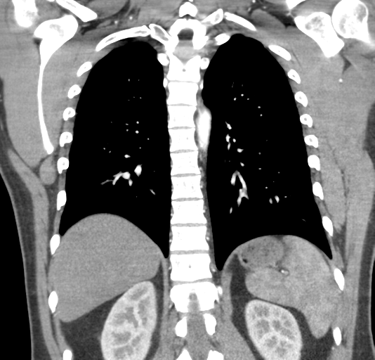 File:Normal CTA thorax (non ECG gated) (Radiopaedia 41750-44704 B 62).png