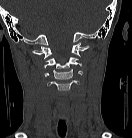 File:Normal CT cervical spine - 12-year-old (Radiopaedia 55352-61775 Coronal bone window 84).jpg
