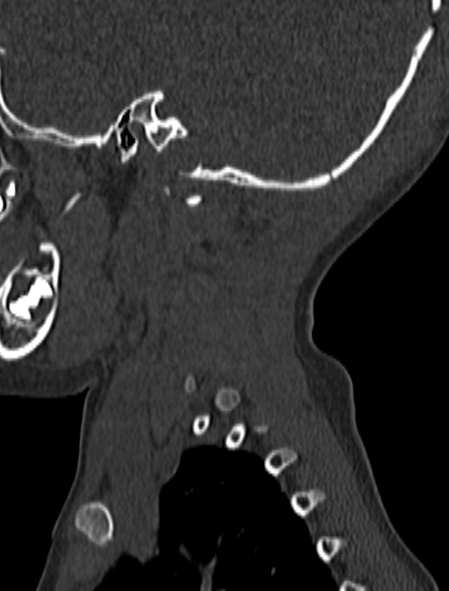 Normal CT cervical spine - pediatric (Radiopaedia 52549-58462 Sagittal bone window 4).jpg