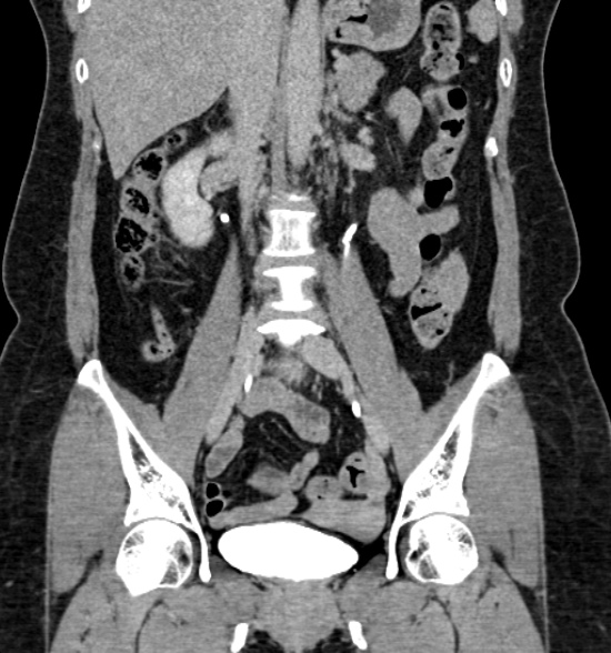 Normal CT intravenous urogram (Radiopaedia 39444-41759 A 272).jpg