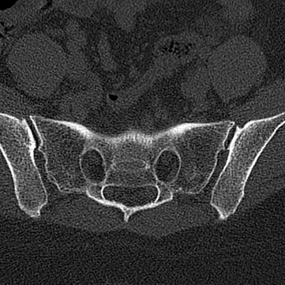 File:Normal CT lumbar spine (Radiopaedia 53981-60118 Axial bone window 72).jpg
