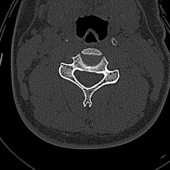 Normal CT of the cervical spine (Radiopaedia 53322-59305 Axial bone window 127).jpg