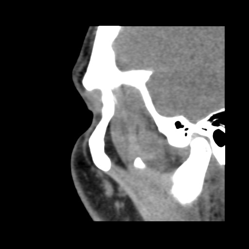 Normal CT paranasal sinuses (Radiopaedia 42286-45390 F 30).jpg