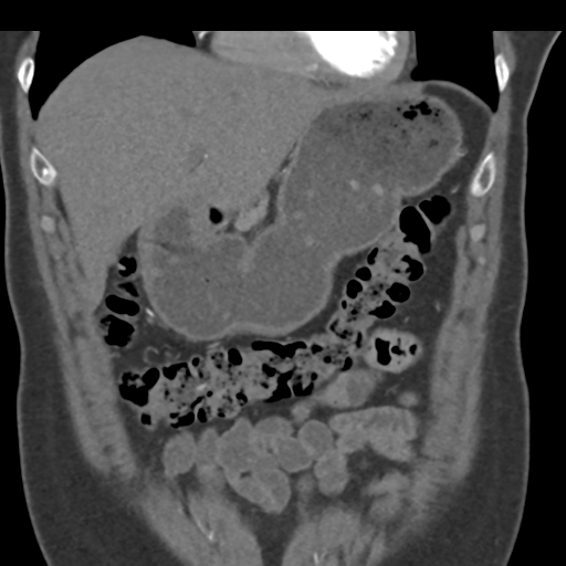 File:Normal CT renal artery angiogram (Radiopaedia 38727-40889 B 22).png