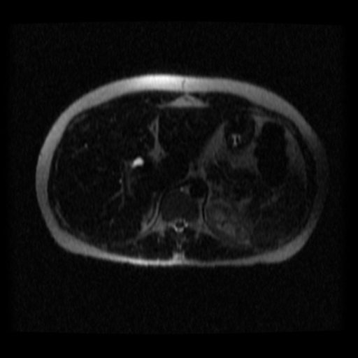 File:Normal MRCP (Radiopaedia 41966-44978 Axial T2 thins 24).png