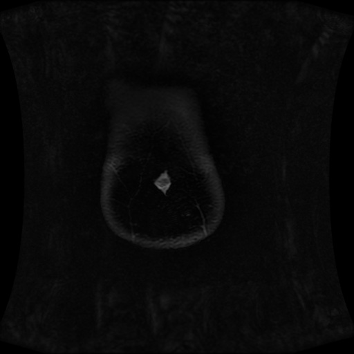 Normal MRI abdomen in pregnancy (Radiopaedia 88001-104541 M 14).jpg
