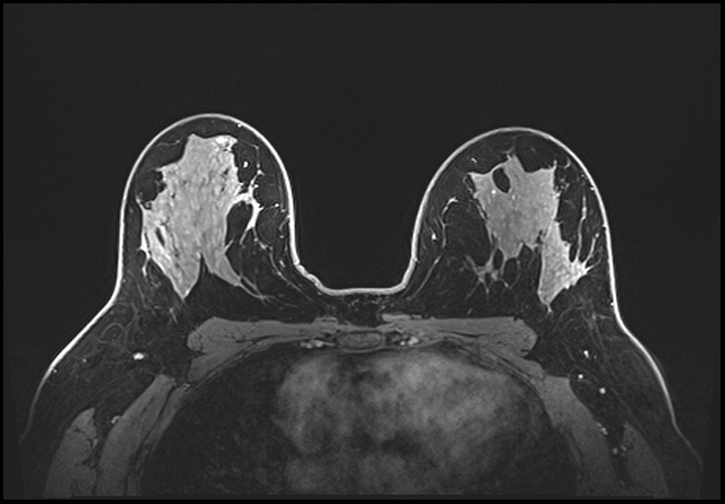 Normal breast MRI - dense breasts (Radiopaedia 80454-93850 C 133).jpg
