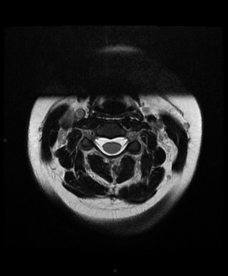 Normal cervical spine MRI (Radiopaedia 80146-93454 Axial T2 30).jpg