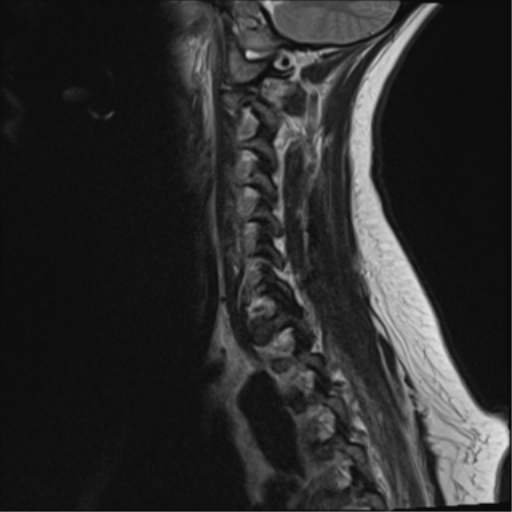 File:Normal cervical spine MRI (including Dixon) (Radiopaedia 42762-45925 Dixon- in-phase 13).png