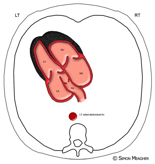 File:Normal fetal echocardiogram (Radiopaedia 26830-26994 A 1).jpg