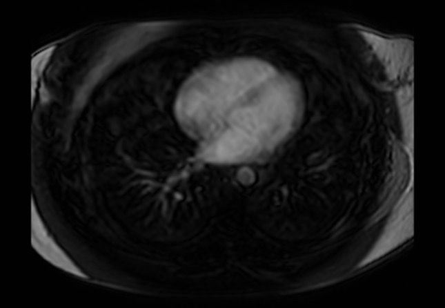 Normal liver MRI with Gadolinium (Radiopaedia 58913-66163 J 84).jpg