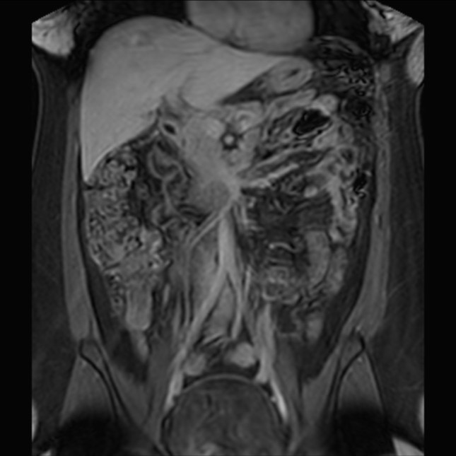 Normal liver MRI with Gadolinium (Radiopaedia 58913-66163 P 39).jpg
