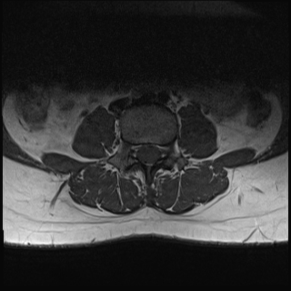 File:Normal lumbar spine MRI- 3 T (Radiopaedia 53280-59250 Axial 14).jpg