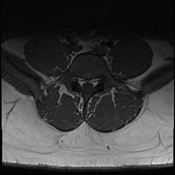 File:Normal lumbar spine MRI (Radiopaedia 47857-52609 Axial T1 23).jpg