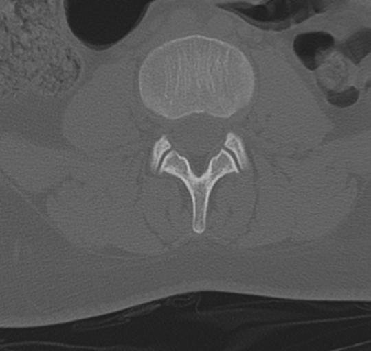 File:Normal lumbosacral CT (Radiopaedia 37923-39867 Axial bone window 58).png