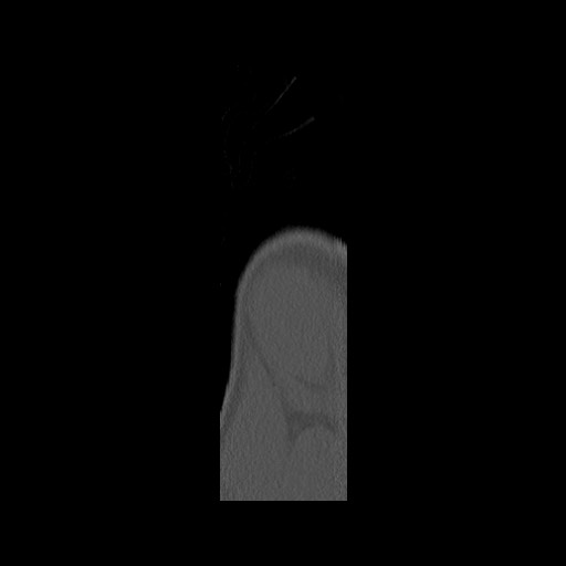 Normal pelvis (Radiopaedia 51473-57238 Sagittal bone window 1).jpg