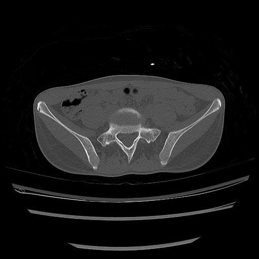 Normal pelvis CT (Radiopaedia 51471-57236 Axial bone window 19).jpg