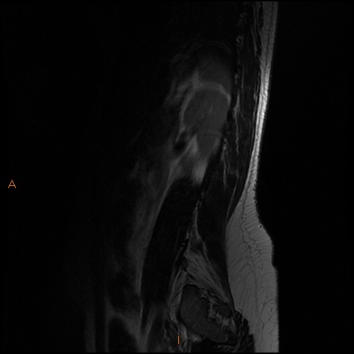 File:Normal spine MRI (Radiopaedia 77323-89408 Sagittal T2 14).jpg
