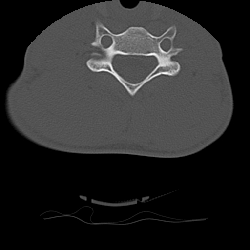 File:Normal trauma spine imaging (age 16) (Radiopaedia 45335-49358 Axial bone window 54).jpg