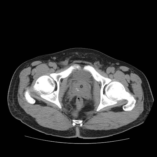 File:Obstructed kidney with perinephric urinoma (Radiopaedia 26889-27067 Axial non-contrast 38).jpg