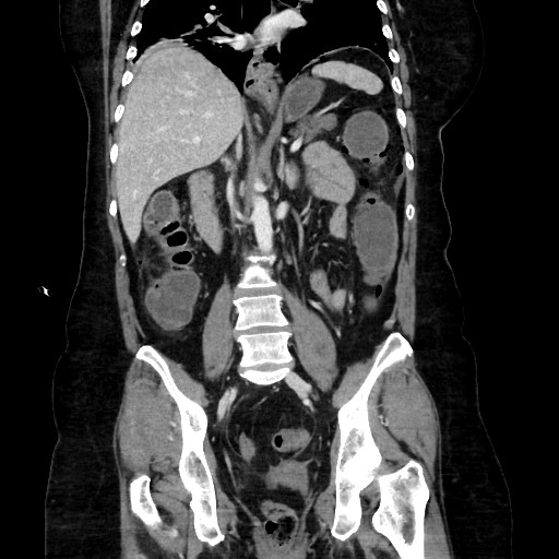 Obstructive distal colonic adenocarcinoma causing cecal perforation (Radiopaedia 86830-102989 C 109).jpg