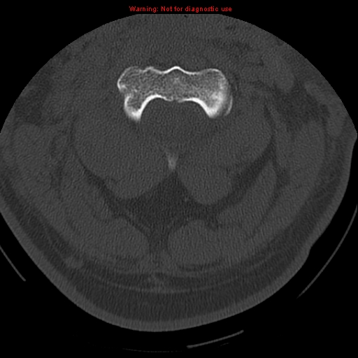 File:Occipital condyle fracture (Radiopaedia 18366-18208 Axial bone window 24).jpg